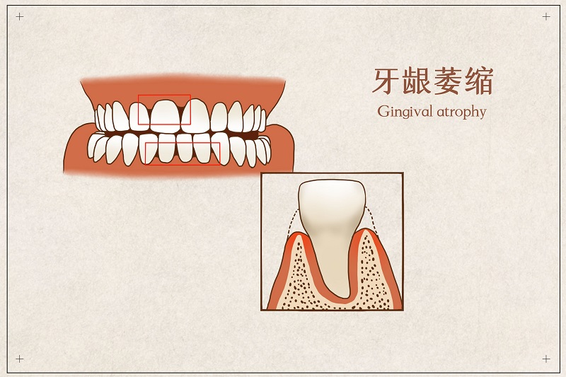 攝圖網(wǎng)_401804075_banner_牙齦萎縮醫(yī)療插畫(huà)（企業(yè)商用）.jpg