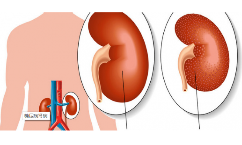 腎病演化成尿毒癥的原因